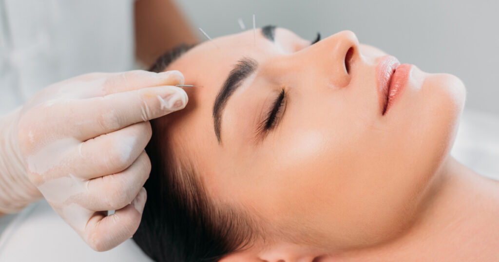 Blog Image AcuNova Acupuncture